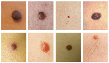 Cele mai frecvente pete de pe piele – este alunițele și papilloma (negii)
