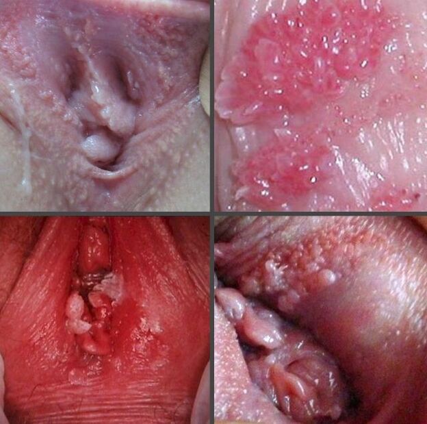 Aproape de papiloame în vagin