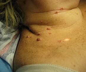 Virusul papiloma uman pe gât