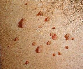 Virusul papiloma uman pe piele